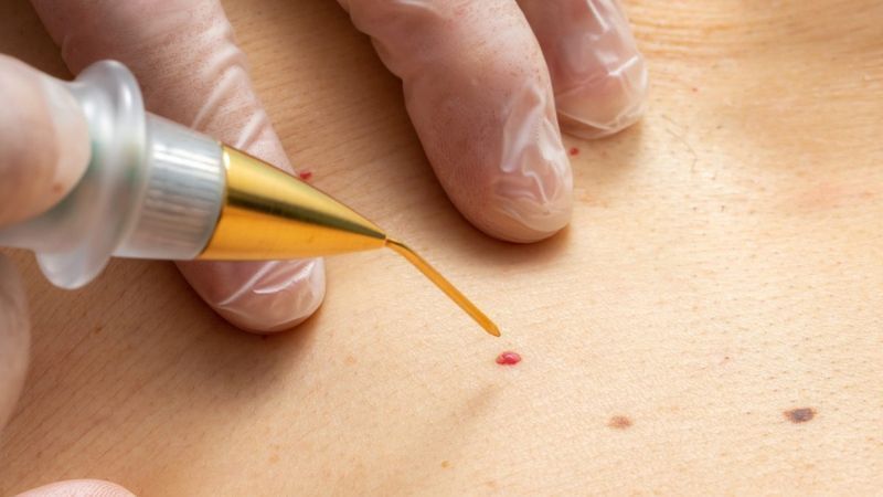Wart And Skin Tag Removal: DIY Vs. Professional ?