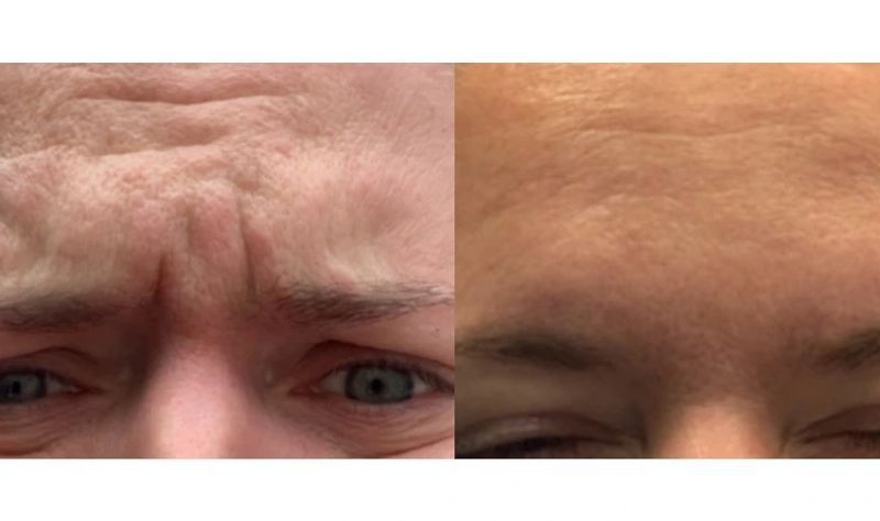 Frown Lines Botox Treatment | Glabellar Lines & 11s Wrinkles