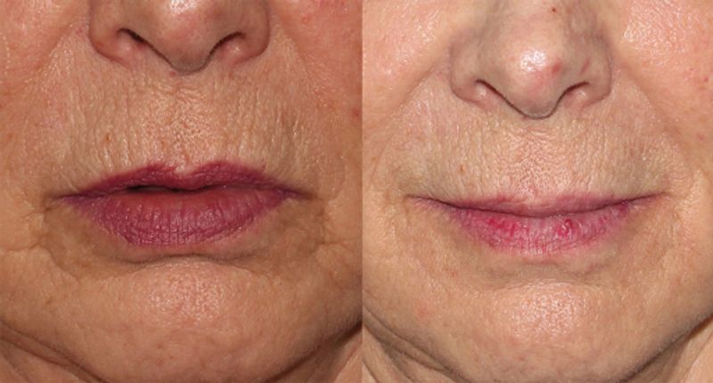 Smoker's Lines Botox Treatment | Vertical Lip Lines & Wrinkles