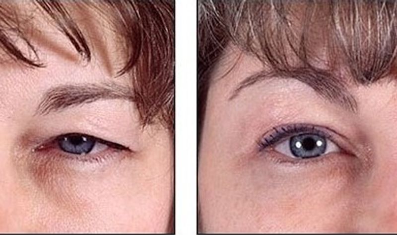 Eyebrow Lift Botox Treatment | Brow Lift & Fox Eye Non-Surgical