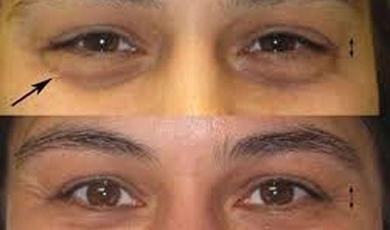 Lower Eyelid Roll Botox Treatment | Jelly Roll & Under Eye Lines