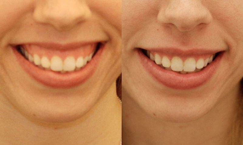 Gummy Smile Botox Treatment | Fix Excessive Gums & Smile Lines