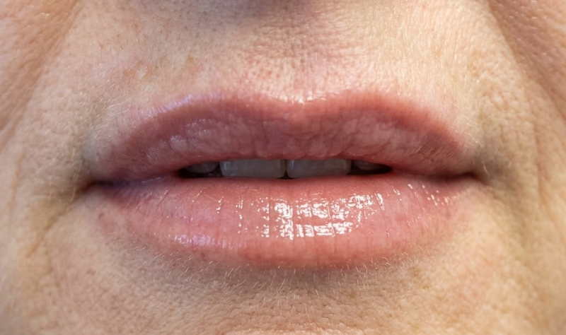 Hyaluronic Acid Lip Fillers | Natural Volume & Fuller Lips Enhancement