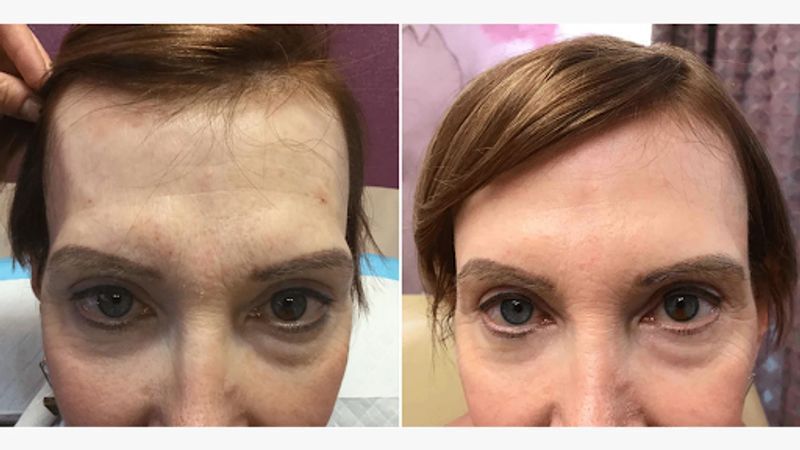 Hyaluronic Acid Temple Fillers | Hollow Temple Volume & Lift