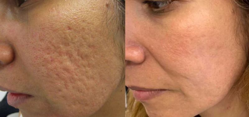 Radiesse CaHA Treatment London ON | Pinkal Medical Aesthetics