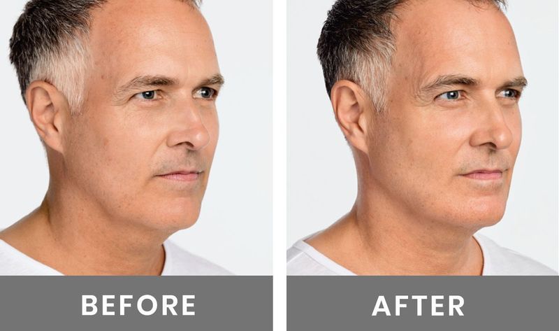 Jawline Contouring Radiesse | Non-Surgical Jaw Definition CaHA