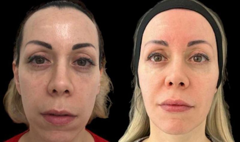 Healthier Skin Radiesse | Biostimulator & Collagen Regeneration