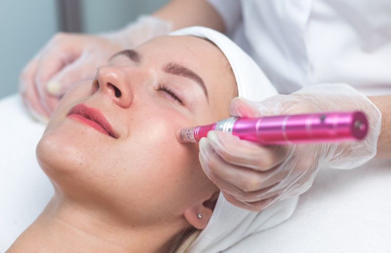 Microneedling Fine Lines & Wrinkles | Collagen Induction