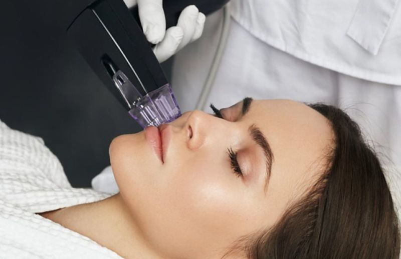 Morpheus8 London ON | Pinkal Medical Aesthetics