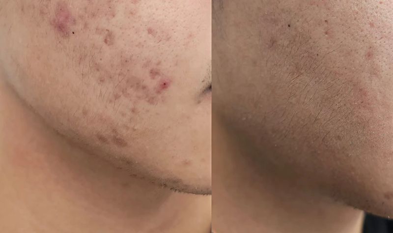Acne & Pimple Treatment London ON | Pinkal Medical Aesthetics