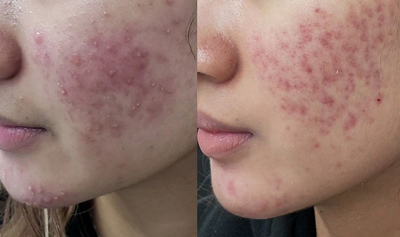 Acne Scar Treatment London ON | Pinkal Medical Aesthetics