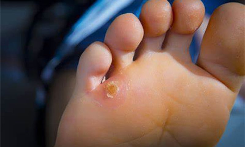 Corn Removal in London ON | Hard & Soft Corns Treatment