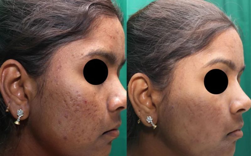 Acne Scars Treatment with PRP | London | Ontario
