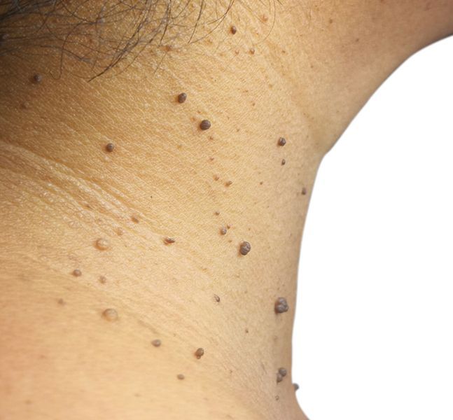 Skin Tags Removal