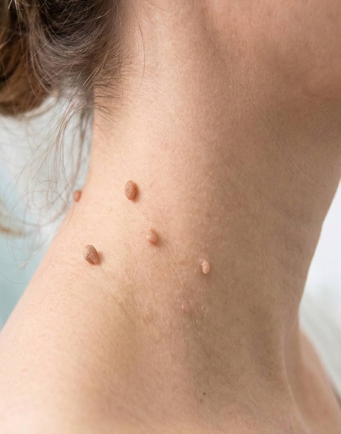 Skin Tag Removal in London,ON – Safe & Painless Treatment