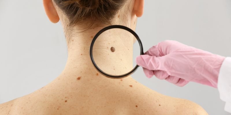 Mole Removal in London, ON – Safe & Scar-Free Treatment