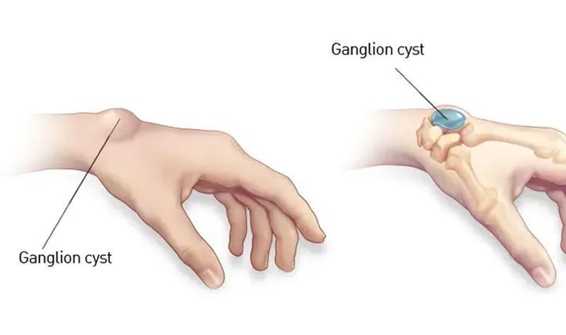 Ganglion Cyst Removal | Wrist & Hand Lump Treatment