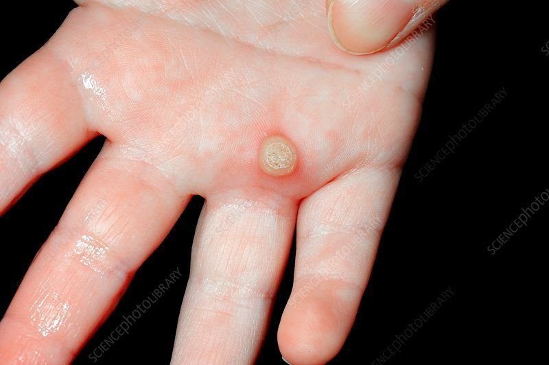 Wart Removal | Safe & Scar-Free Wart Treatment | Pinkal Medical Aesthetics