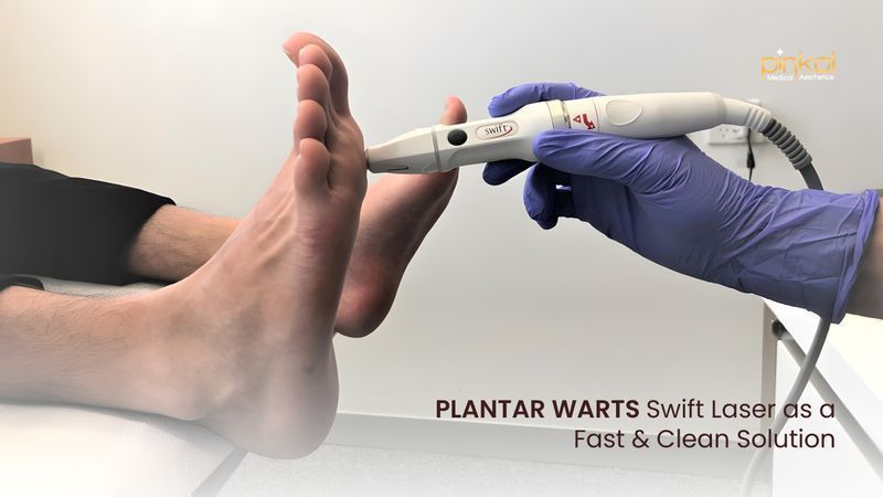 Swift Laser Therapy for Plantar Warts Removal
