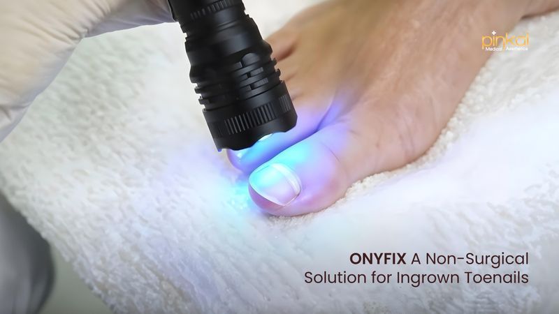 Pain-Free Ingrown Toenail Treatment with OnyFix