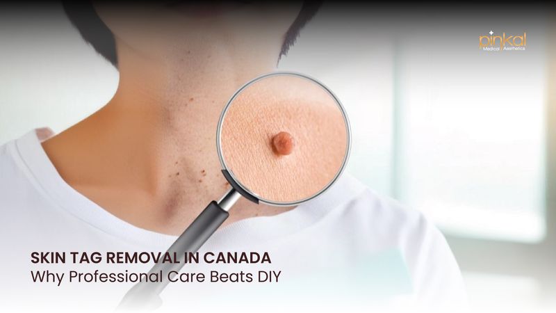 Skin Tag Removal in Canada: Why Professional Care Beats DIY