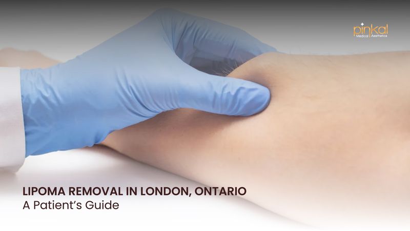 Lipoma Removal in London, Ontario | Patient’s Guide & Treatment Options