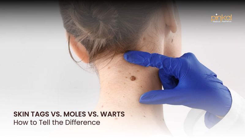 Skin Tags vs. Moles vs. Warts | How to Tell the Difference in London, Ontario