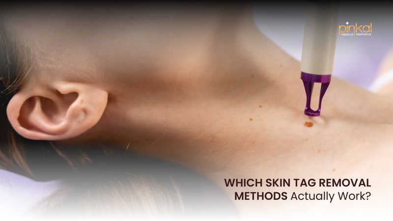 Which Skin Tag Removal Methods Work? | Safe Options in London, Ontario
