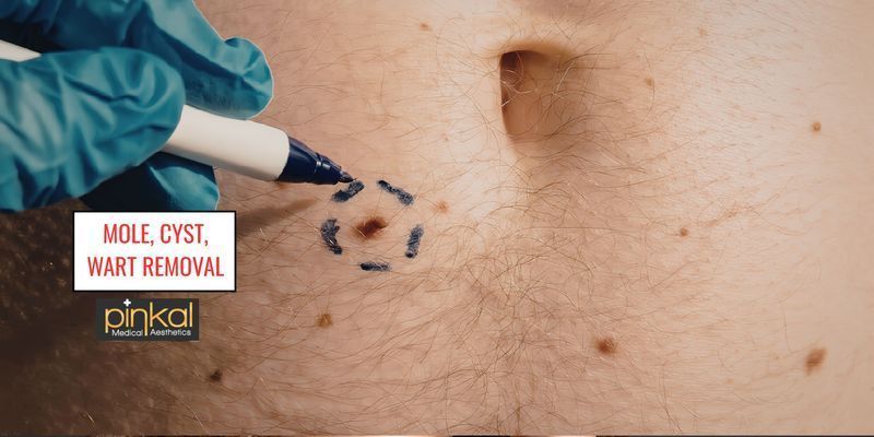 Mole Removal in London Ontario: Methods, Costs & What’s Best for You