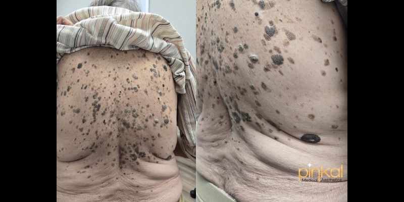 Get Summer Ready: Say Goodbye to Wisdom Spots and Barnacles