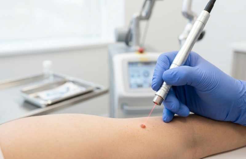 Co2 Laser Mole Removal